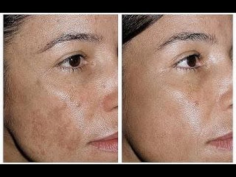 Cómo eliminar manchas marrones de los granos de maíz