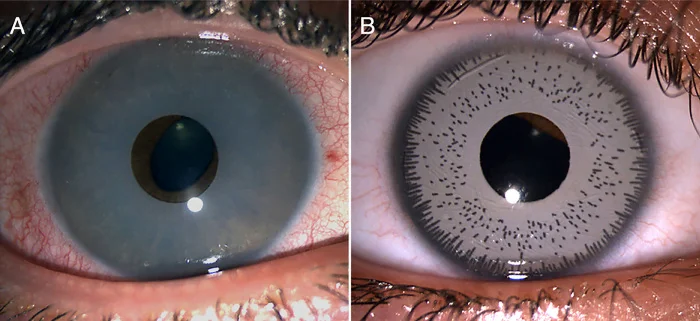 Cómo se realizan el trasplante y la división de los iris