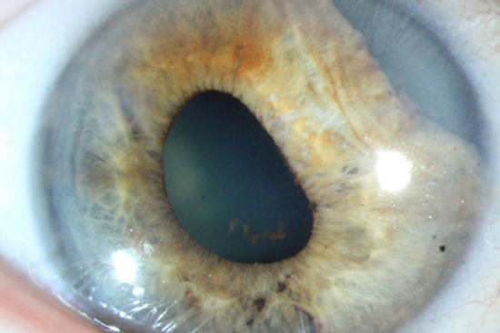 Cómo tratar daños en el iris causados por un taladro