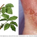 Plantas con gloquidios: Cómo prevenir irritación en la piel